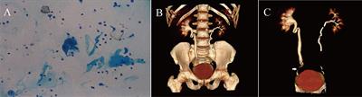 Case Report: Step-by-step procedures for total intracorporeal laparoscopic kidney autotransplantation in a patient with distal high-risk upper tract urothelial carcinoma